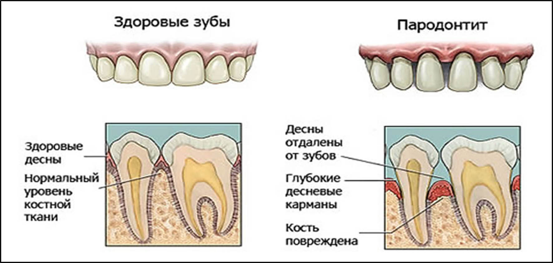 Кровяной сгусток после удаления зуба