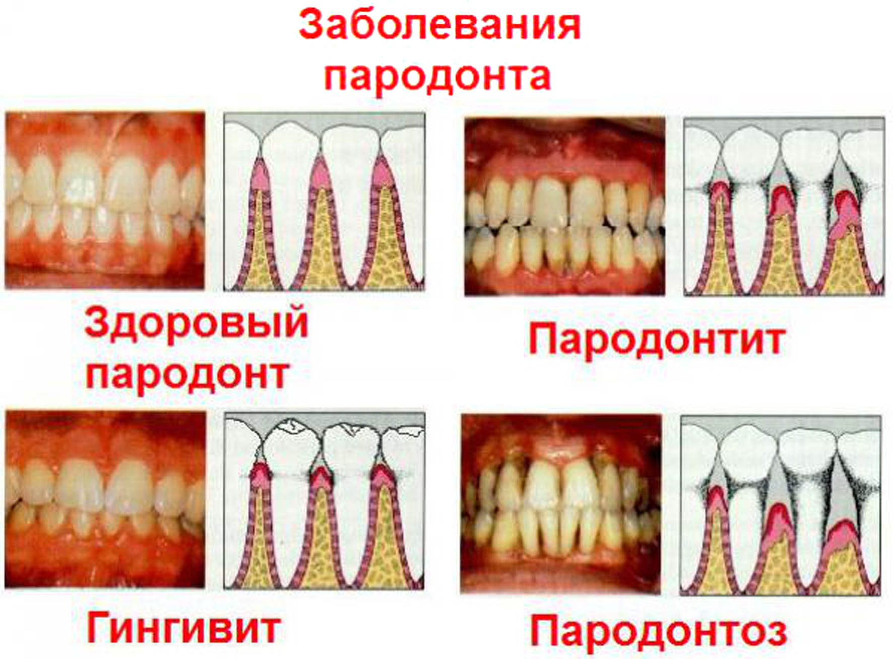 Сколько времени (дней) заживает десна после удаления зуба
